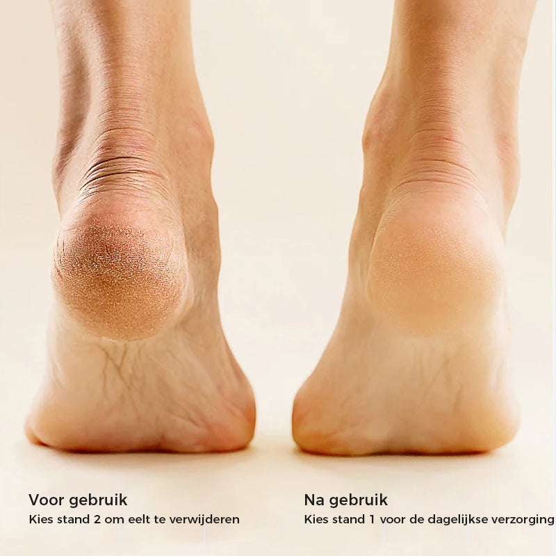 Oplaadbare elektrische voeteeltverwijderaar