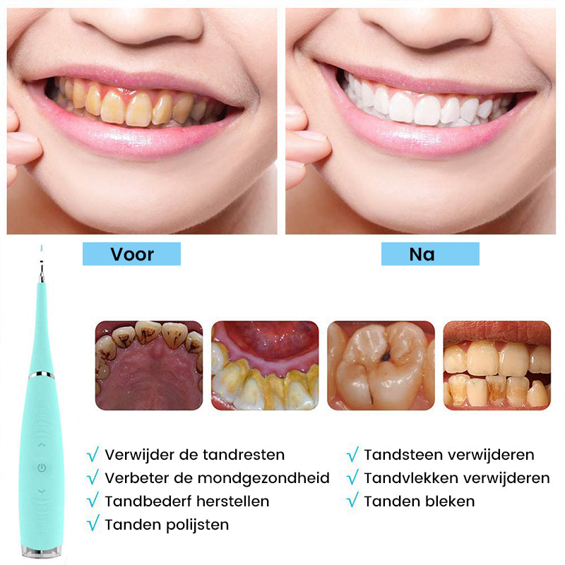 Ultrasone tandenreiniger