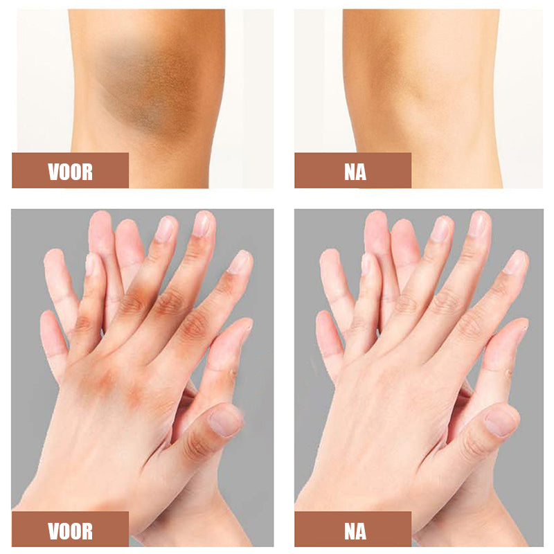 Donkere knieën en ellebogen Sterke bleekcrème