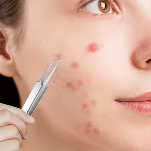 Professioneel gezichts-mee-eterverwijderaarpincet